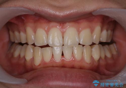 マスクをすると口臭が気になるの症例 治療後