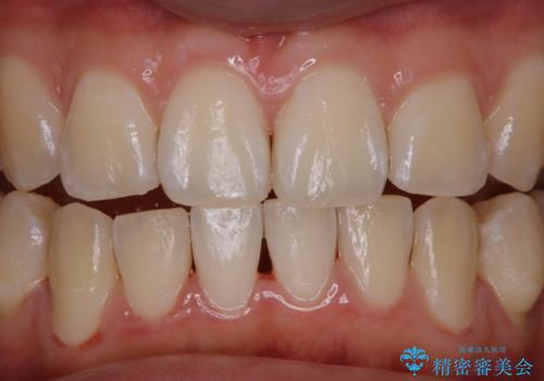 マスクをすると口臭が気になるの治療後