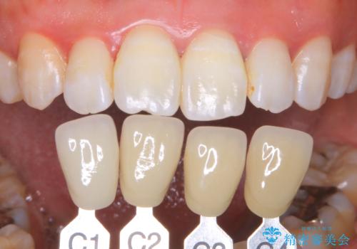 歯を白くしたい‐ウォーキングブリーチで内側から白くの治療後