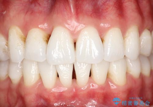 インビザライン終了時のPMTCの治療前