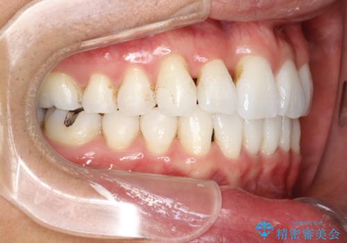 インビザライン終了時のPMTCの治療前