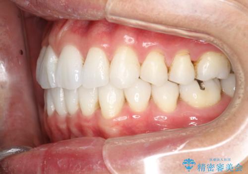 インビザライン終了時のPMTCの治療前