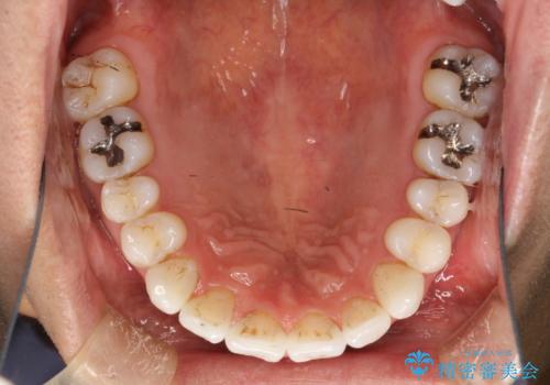 インビザライン終了時のPMTCの治療前