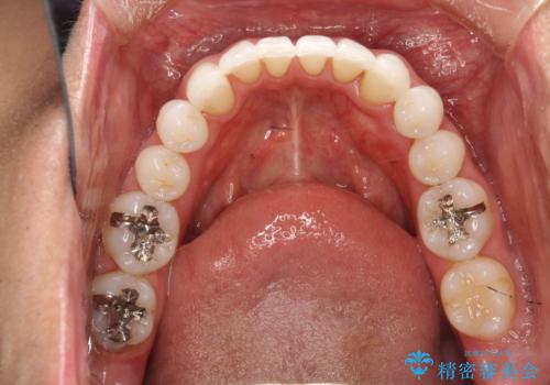 インビザライン終了時のPMTCの治療前