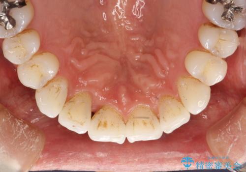 インビザライン終了時のPMTCの治療前