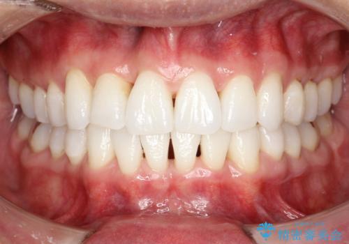 インビザライン終了時のPMTCの症例 治療後