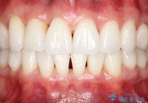 インビザライン終了時のPMTC