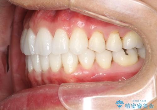 インビザライン終了時のPMTCの治療後