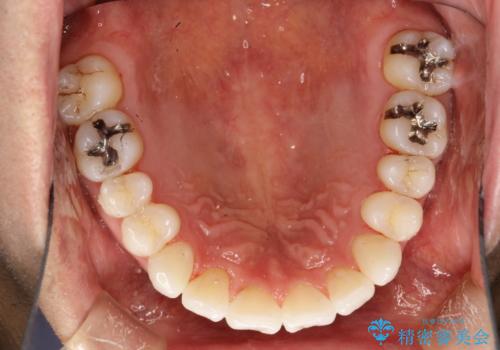 インビザライン終了時のPMTCの治療後