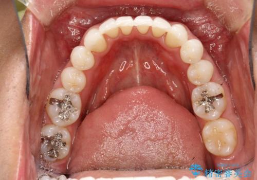 インビザライン終了時のPMTCの治療後