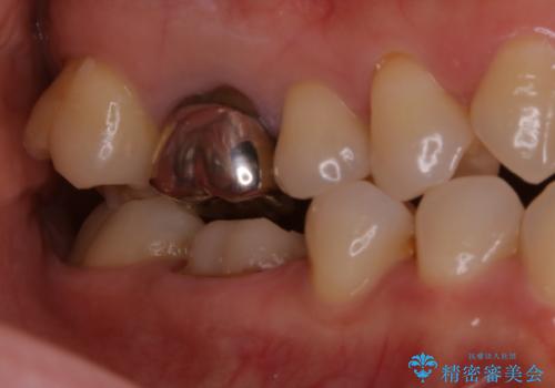 被せ物の下で進行してしまった虫歯の治療の治療中