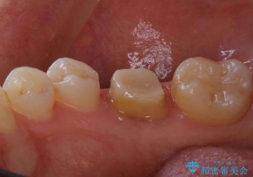 被せ物の下で進行してしまった虫歯の治療の治療中