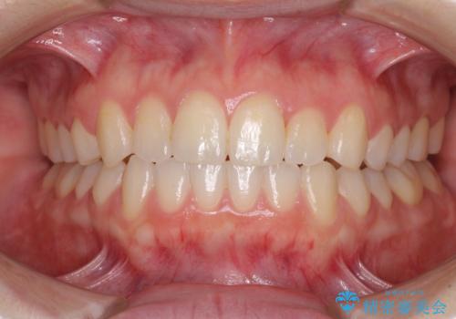 前歯のクロスバイトをインビザライン矯正で改善の症例 治療後