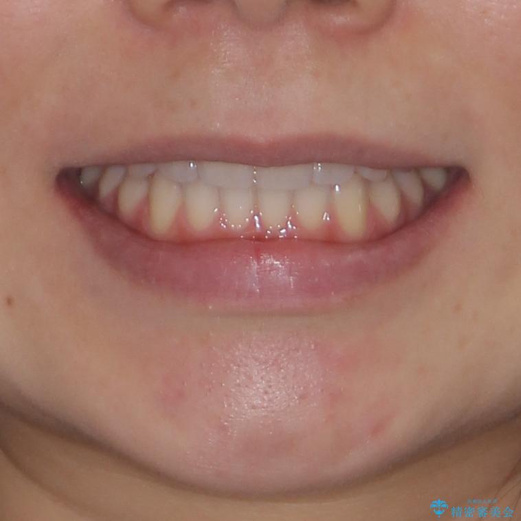 前歯のクロスバイトをインビザライン矯正で改善の治療後（顔貌）