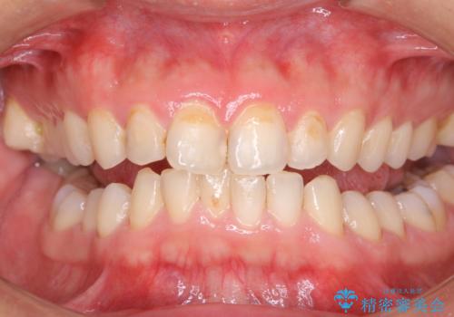 30年ぶりに歯科医院へ来院 クリーニングと口腔内のチェックの症例 治療前