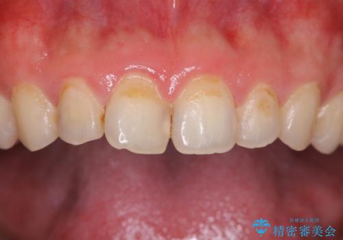 30年ぶりに歯科医院へ来院 クリーニングと口腔内のチェックの治療前