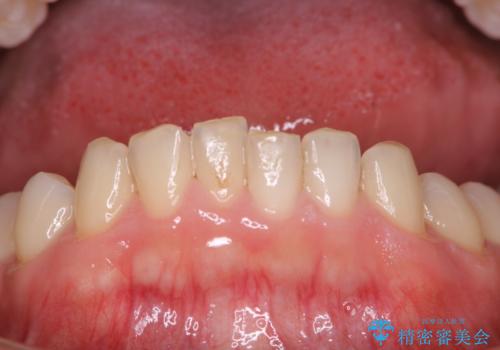 30年ぶりに歯科医院へ来院 クリーニングと口腔内のチェックの治療前