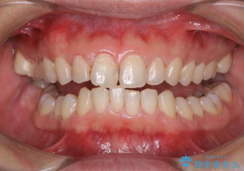 30年ぶりに歯科医院へ来院 クリーニングと口腔内のチェックの症例 治療後