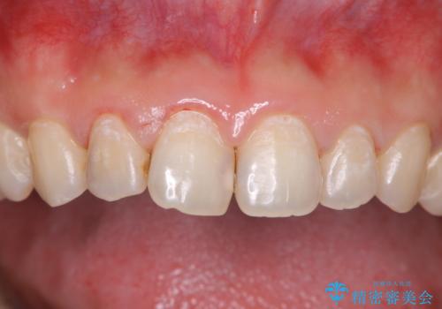 30年ぶりに歯科医院へ来院 クリーニングと口腔内のチェックの治療後