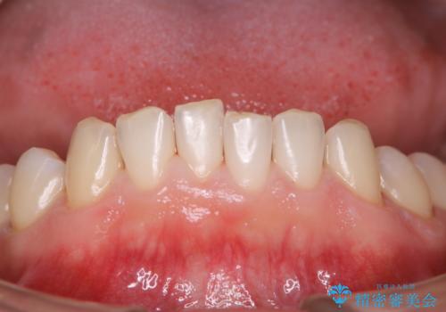 30年ぶりに歯科医院へ来院 クリーニングと口腔内のチェックの治療後