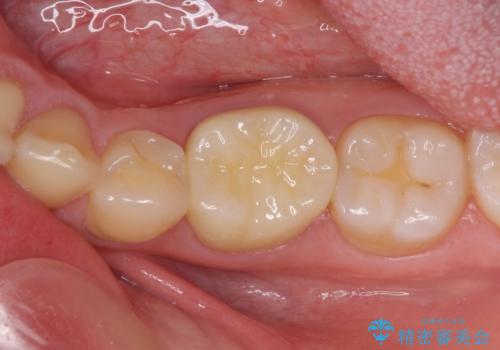 神経近くにまで及んだ大きなむし歯のセラミッククラウンの治療後