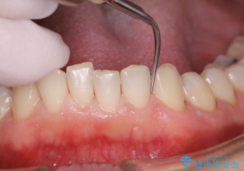 30年ぶりに歯科医院へ来院 クリーニングと口腔内のチェックの治療中