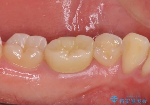 神経近くにまで及んだ大きなむし歯のセラミッククラウンの治療後