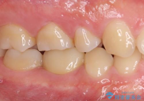 神経近くにまで及んだ大きなむし歯のセラミッククラウンの治療後