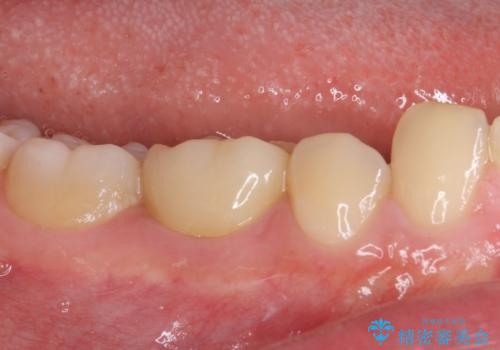 神経近くにまで及んだ大きなむし歯のセラミッククラウンの治療後