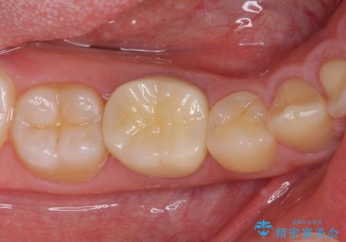 神経近くにまで及んだ大きなむし歯のセラミッククラウンの治療後