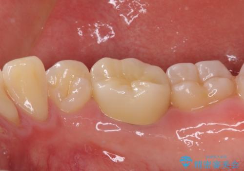 神経近くにまで及んだ大きなむし歯のセラミッククラウンの治療後