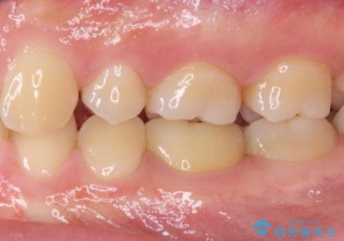 神経近くにまで及んだ大きなむし歯のセラミッククラウンの治療後