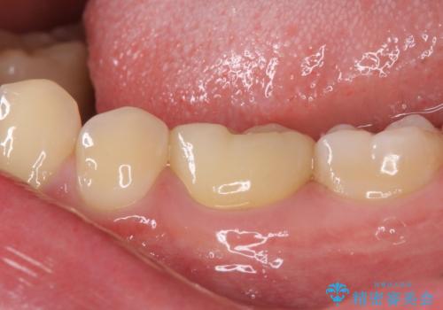 神経近くにまで及んだ大きなむし歯のセラミッククラウンの治療後