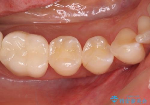奥歯がしみる　セラミックインレーによるむし歯治療の症例 治療後