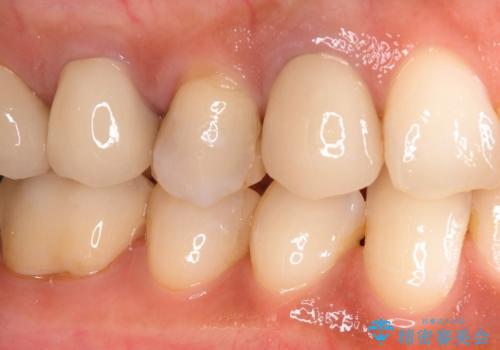 奥歯がしみる セラミックインレーによるむし歯治療の治療後