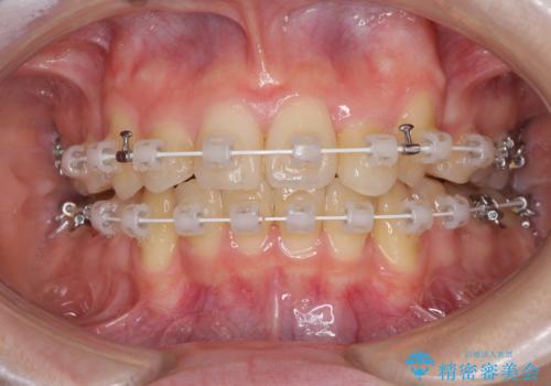 気になる八重歯を治したい ワイヤー装置での抜歯矯正の治療中