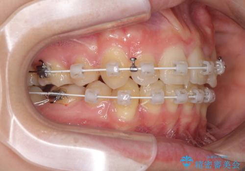 気になる八重歯を治したい ワイヤー装置での抜歯矯正の治療中