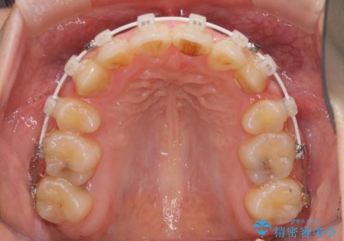 気になる八重歯を治したい ワイヤー装置での抜歯矯正の治療中