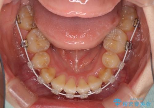 気になる八重歯を治したい ワイヤー装置での抜歯矯正の治療中