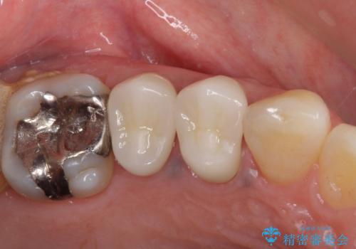 治療途中で放置していた歯 オールセラミッククラウンによる補綴治療の症例 治療後