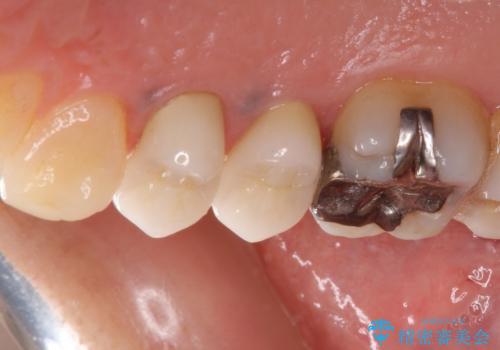 治療途中で放置していた歯 オールセラミッククラウンによる補綴治療の治療後