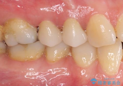 治療途中で放置していた歯 オールセラミッククラウンによる補綴治療の治療後