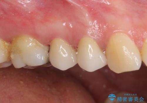 治療途中で放置していた歯 オールセラミッククラウンによる補綴治療の治療後