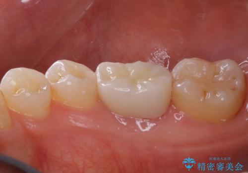 被せ物の下で進行してしまった虫歯の治療の治療後