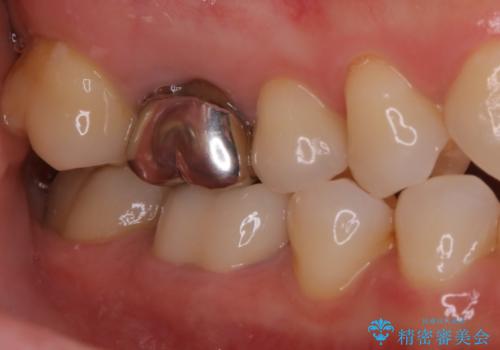 被せ物の下で進行してしまった虫歯の治療の治療後