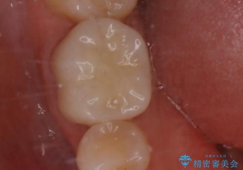 被せ物の下で進行してしまった虫歯の治療の治療後
