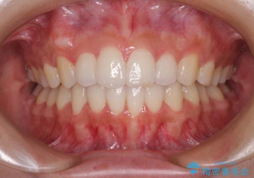 前歯のデコボコと突出感 インビザラインで改善の症例 治療後