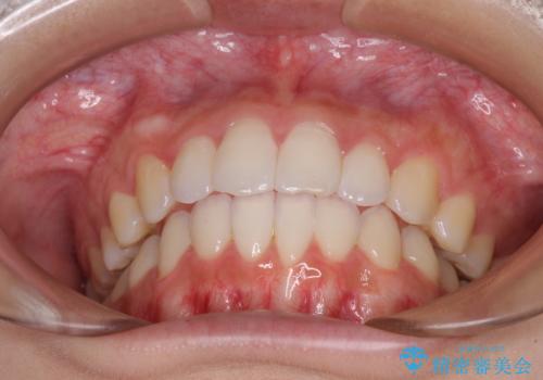 前歯のデコボコと突出感 インビザラインで改善の治療後