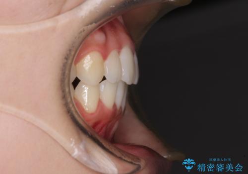 前歯のデコボコと突出感 インビザラインで改善の治療後