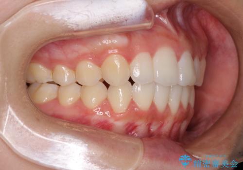 前歯のデコボコと突出感 インビザラインで改善の治療後